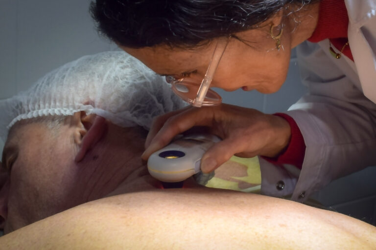 Salud promueve la consulta temprana de revisión de lesiones para prevenir el cáncer de piel